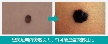 黑痣长大真的会癌变吗?→【医生在线解答】&larr